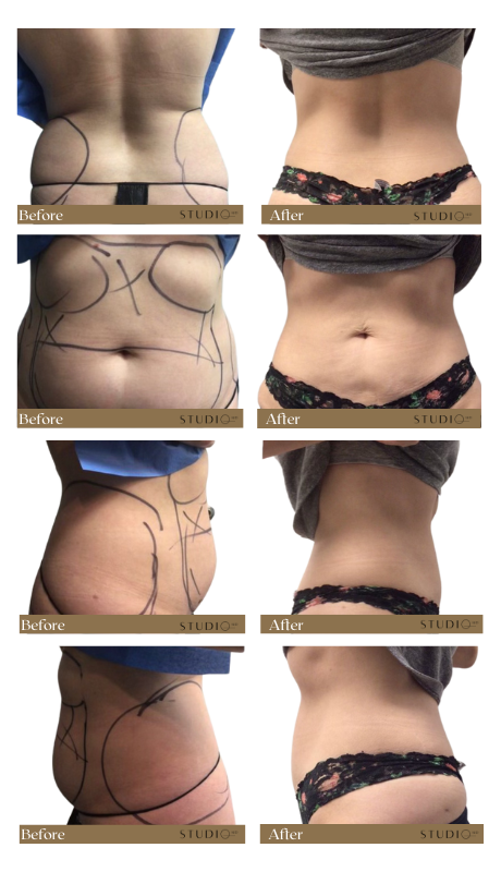 smartlipo 360 before after Yonkers new york